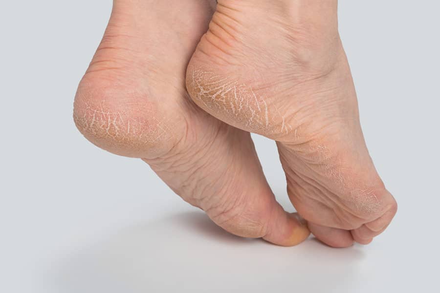 Cuando los pies se secan, experimentas algo de dolor en tus pies y picazón.