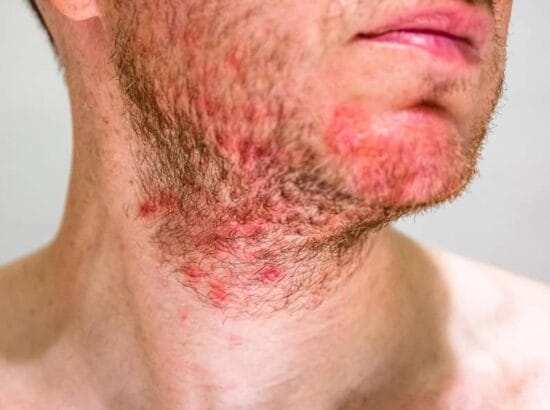 ¿Cómo prevenir la foliculitis o vello enquistado?