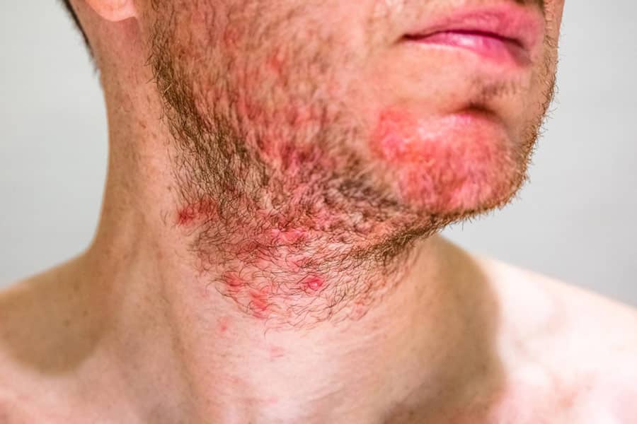 Prevenir la foliculitis con tratamientos faciales en Madrid